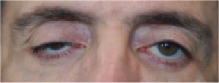 Ptosis Correction