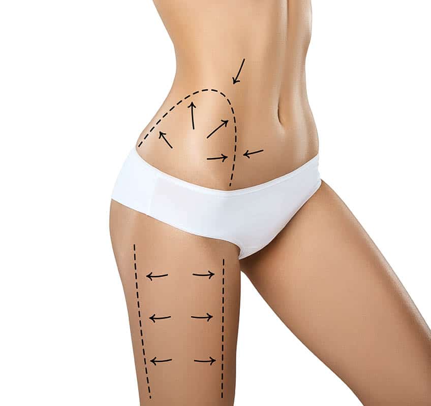 Woman torso in underwear with medical marks for plastic surgery or liposuction