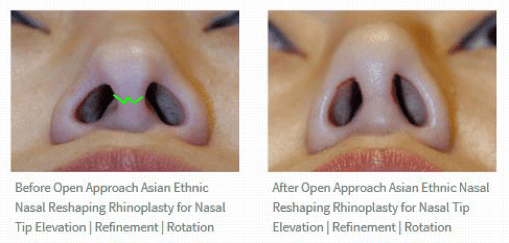 open rhinoplasty