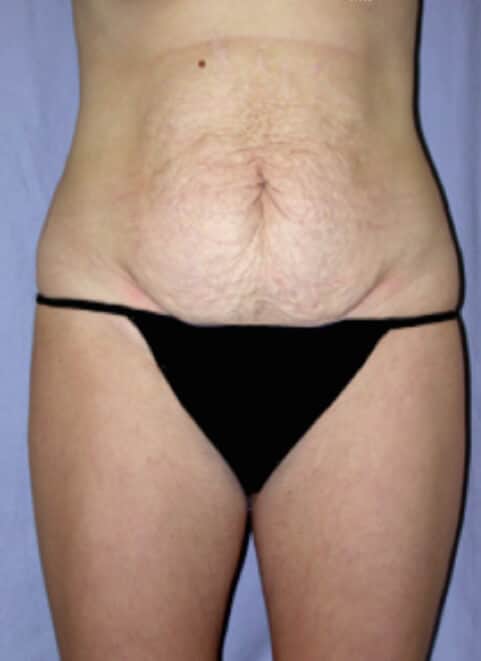 Suitable candidate for a tummy tuck