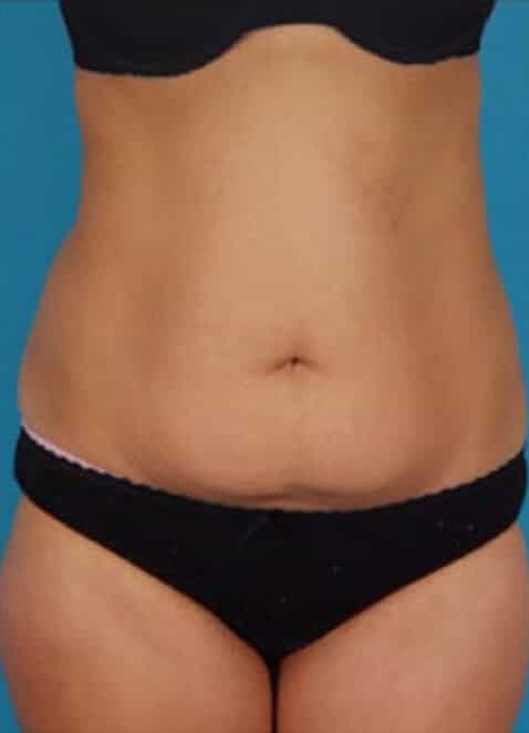 Lipo Abdominoplasty - Tummy Tuck with Liposuction - Shens Clinic