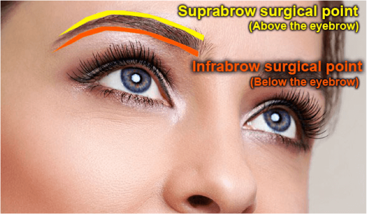 suprabrowlift