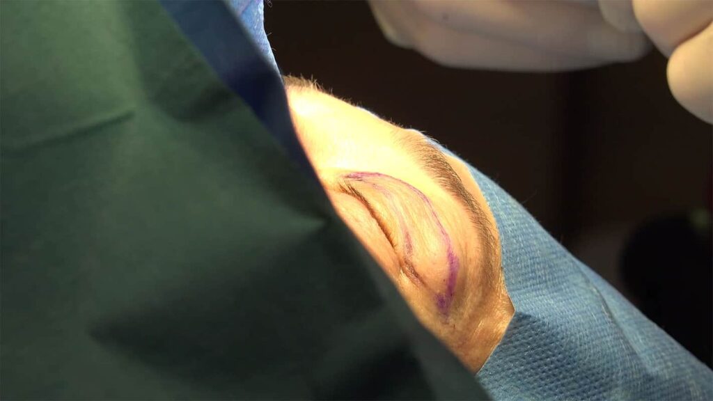 upper blepharoplasty surgery ptosis correction