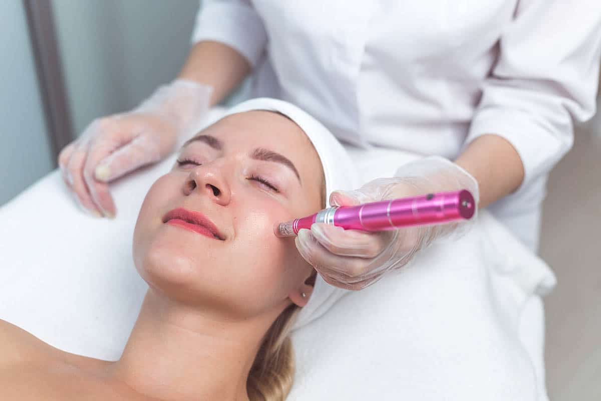 woman having microneedling treatment for facial acne scars
