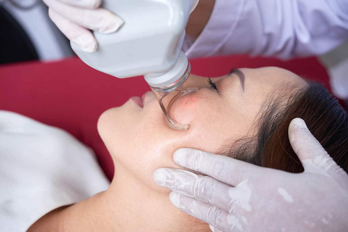 laser treatment for fine lines