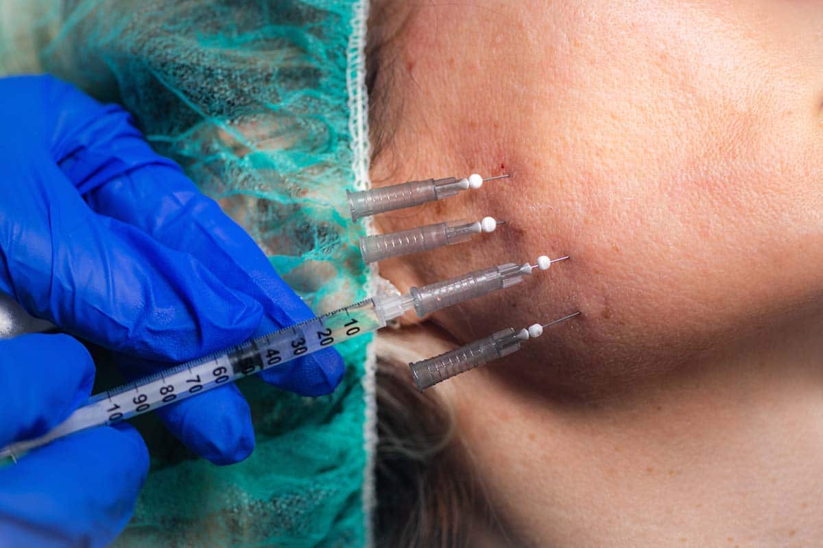 woman having a Non-Surgical V Lift / Thread Face Lift procedure