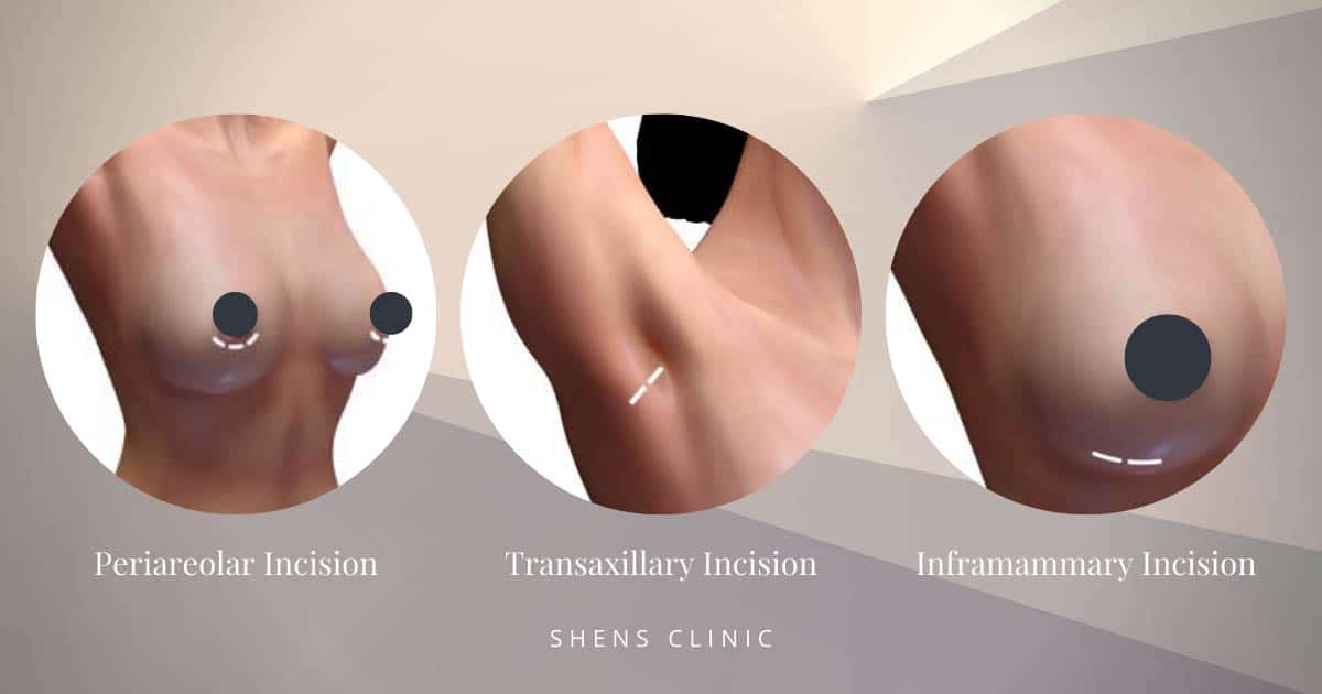 illustrations of the different motiva joy implant incision techniques