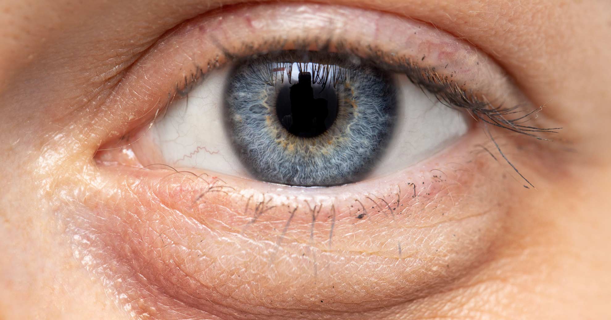 eye-bag-removal