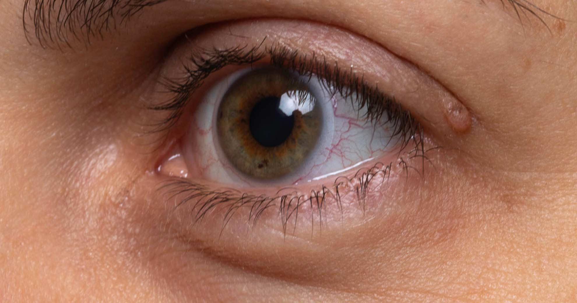 eye-bag-removal
