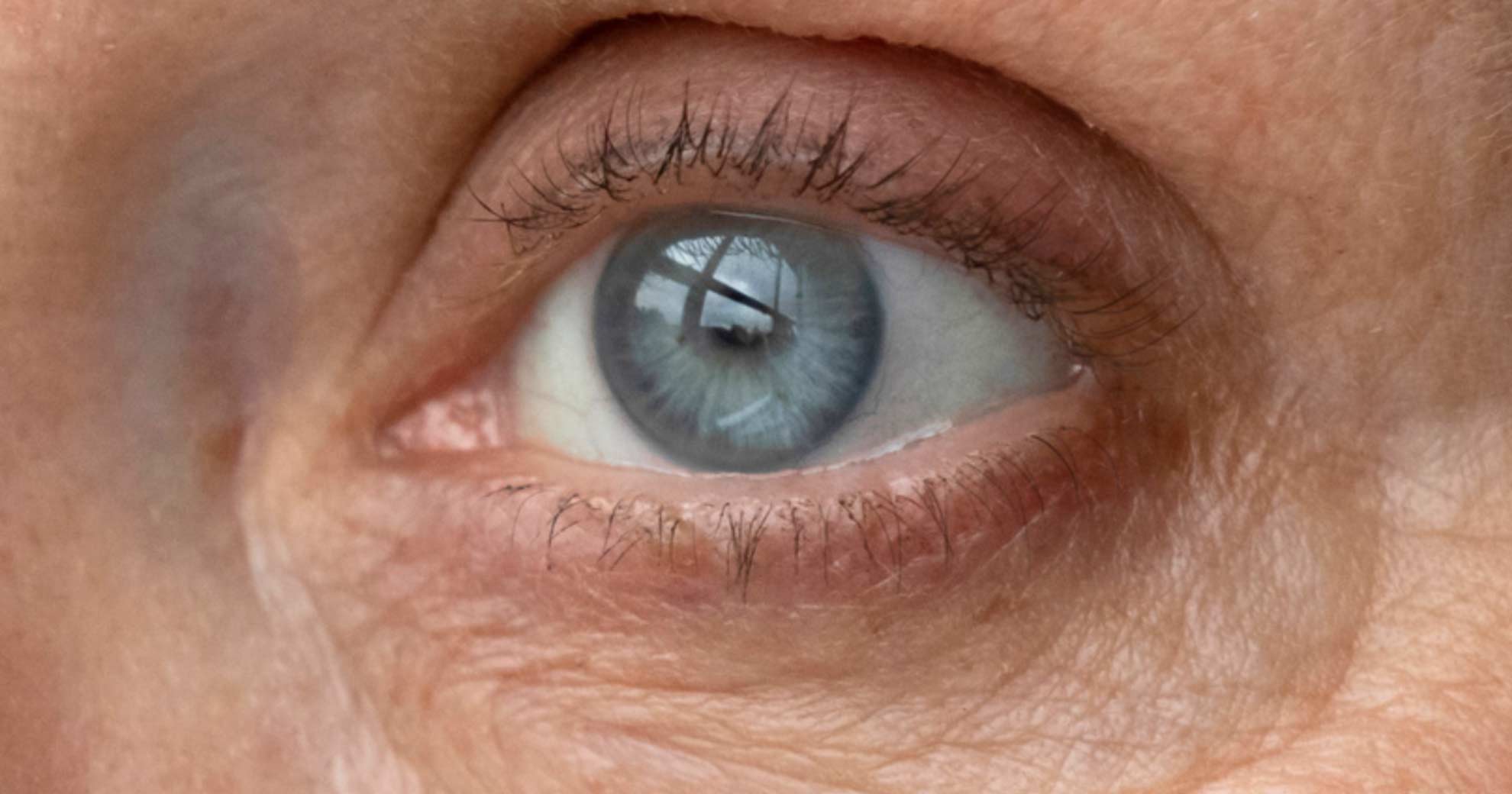 eye-bag-removal