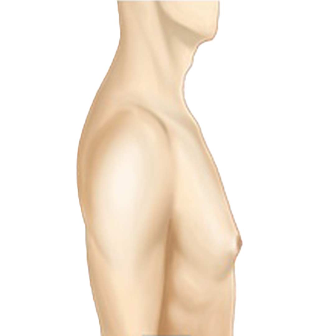 grade-1-gynecomastia