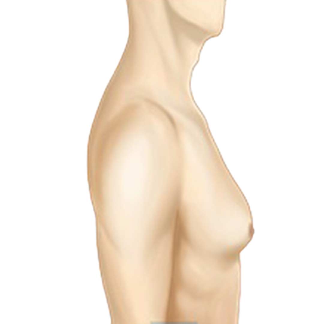 grade-2-gynecomastia