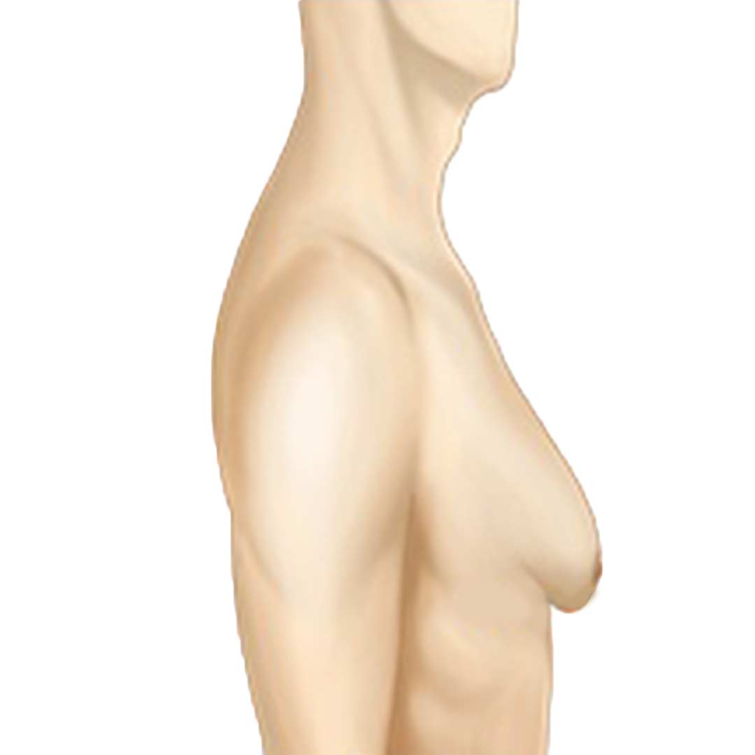 grade-3-gynecomastia