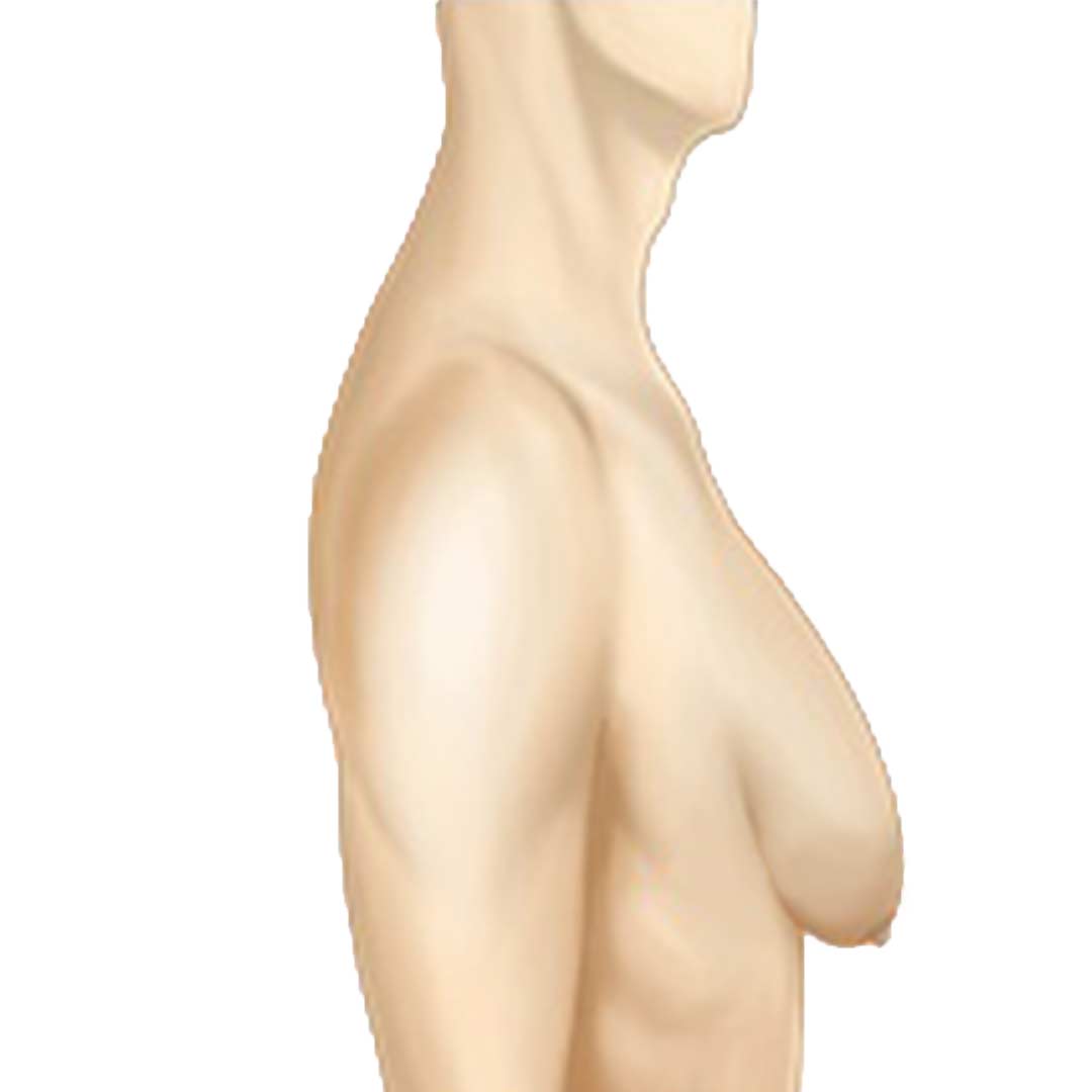 grade-4-gynecomastia