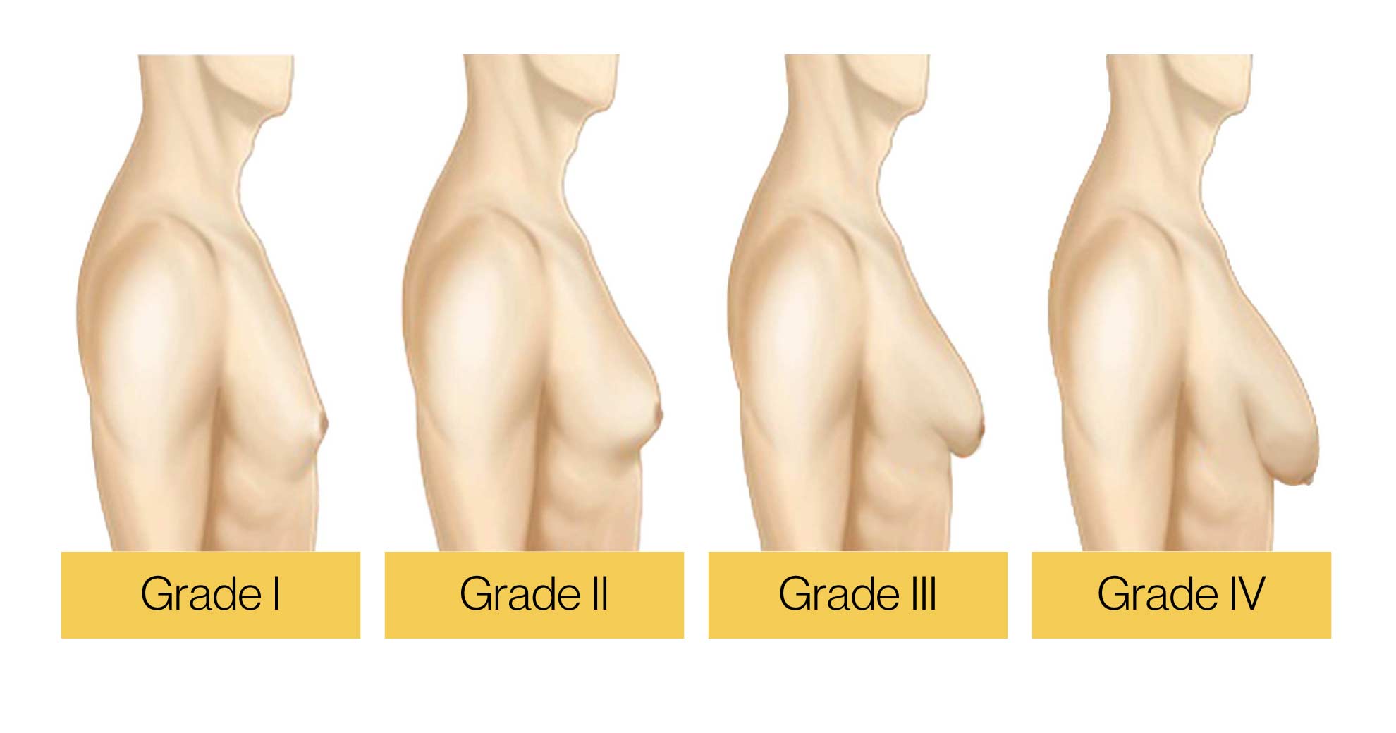 gynecomastia-grade