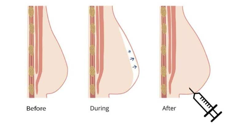 breast-augmentation-breast-fat-grafting