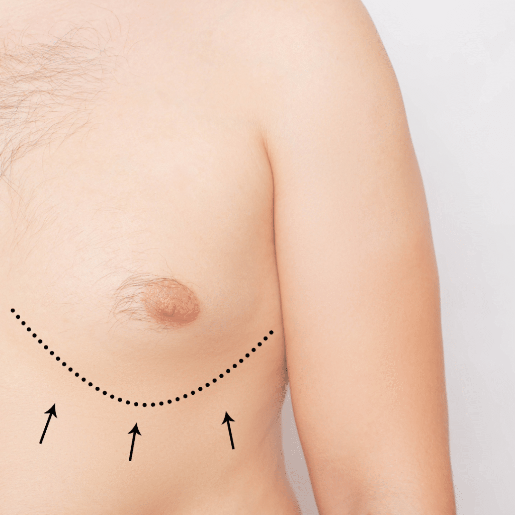 gynecomastia-singapore
