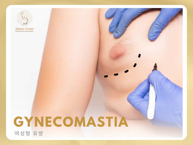 gynecomastia-treatment