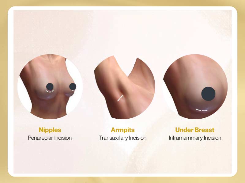 Choice of Breast Implants Incision Methods